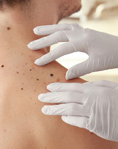 Mole Removal - My Skin Cancer Clinic