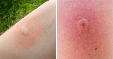 10 insect bites/stings that you should learn to recognize this summer