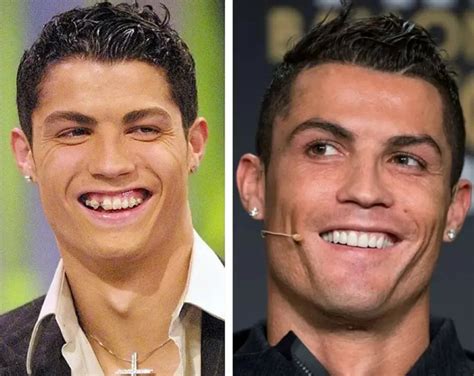 Cristiano Ronaldo Teeth Transformation: A Stunning Smile