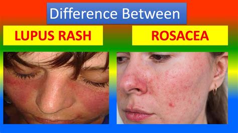 Rosacea Vs Lupus Butterfly Rash