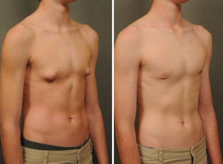 Gynecomastia- myths, reason and treatment - Bombay Cosmetic Clinic