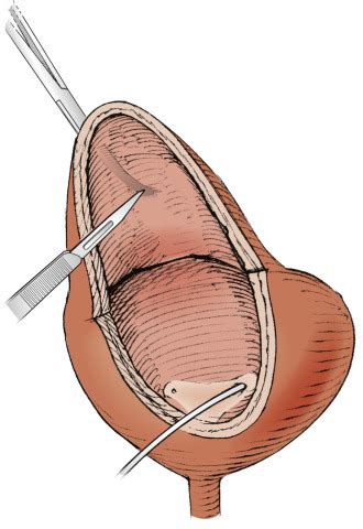 Bladder Flap Repair (Boari) | Abdominal Key