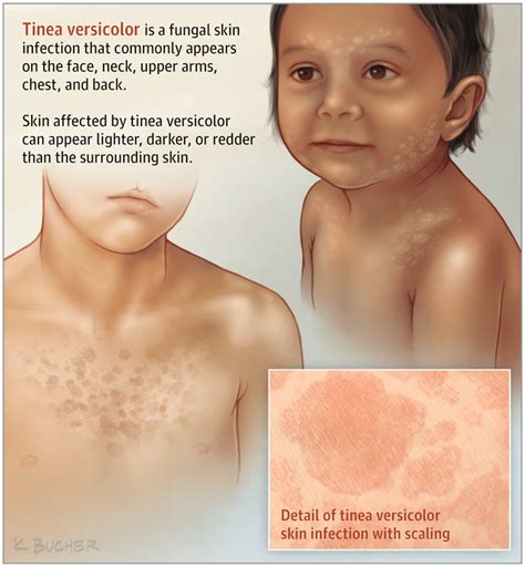 Tinea Versicolor - Know More About It! - By Dr. Radhika Amulraj | Lybrate