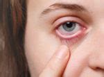 7 Effective Home Remedies To Treat Eye Infections