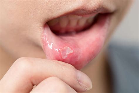 Dealing With Canker Sores Can Be Frustrating...and Painful