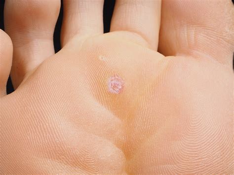 The Causes, Symptoms and Treatment of Plantar Warts