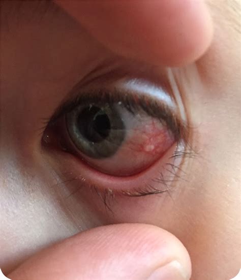 Conjunctival Lesion in a 10-Year-Old Girl | AAFP