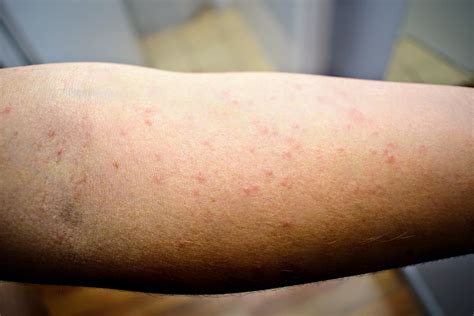 Scabies Pictures Rash Resource Scabies Rashes Scabies - vrogue.co