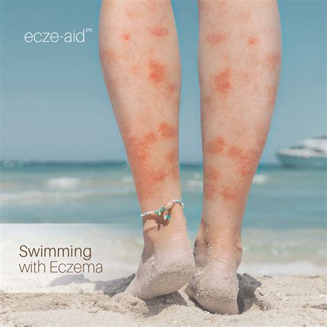 Swimming With Eczema – eczeaid.co