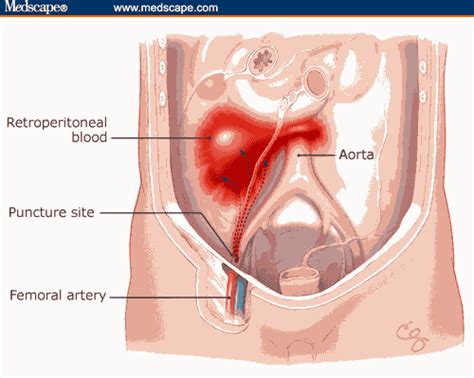 Retroperitoneal Hematoma: 10 Unbelievably Alarming Facts | Thrombocytes