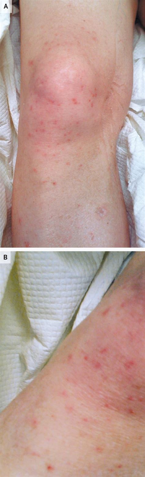 Avoiding a Rash Diagnosis | NEJM