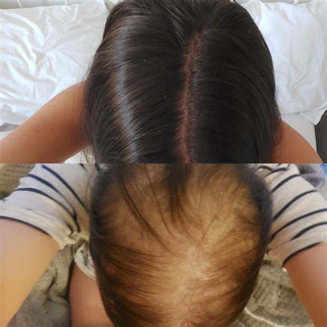 Site line Montgomery Simplify hair loss cold cap before and after Penelope Taiko belly Maryanne ...