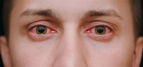 Eye Flu: Causes, Symptoms, Treatment, Prevention