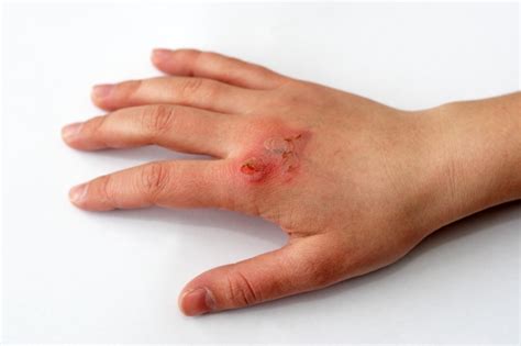 Minor Wound Infection