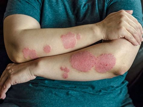 Reasons Why Your Psoriasis Treatment Isn't Working