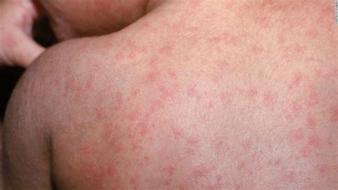 Measles Outbreak Jan 2024 - Evvie Wallis