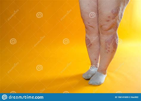 Dermatological Skin Disease. Psoriasis, Eczema, Dermatitis, Allergies Stock Image - Image of ...