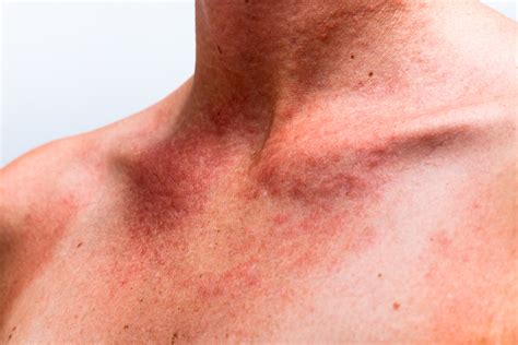 What Can Cause Rash On Neck And Chest | MedicineNet 2021