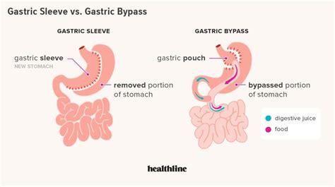 Gastric Sleeve vs. Gastric Bypass: Differences, Pros, Cons | Gastric bypass, Gastric sleeve ...