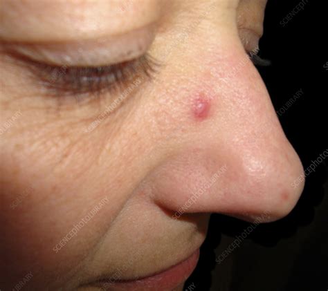 Merkel cell carcinoma on a woman's nose - Stock Image - C058/3265 - Science Photo Library