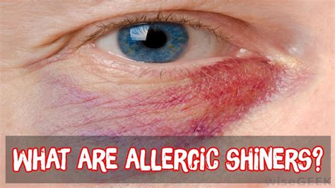 What are allergic shiners? - YouTube