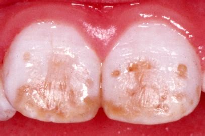 Causes Of Dental Fluorosis