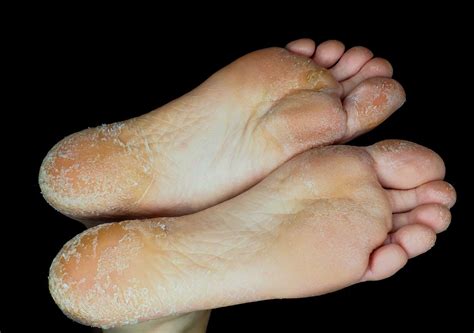 13 Causes of an Itchy Foot