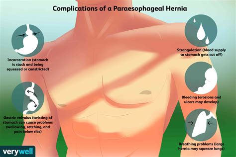 How to fix a hiatal hernia yourself - mzaertopia