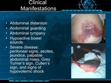 Acute pancreatitis