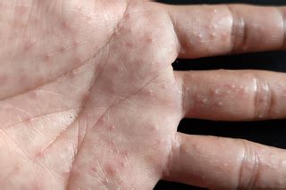 Top 10 eczema on hands and feet 2022