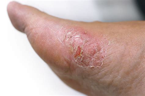 Diabetes and Skin Problems: Know About Diabetic Skin Disorder Causes ...