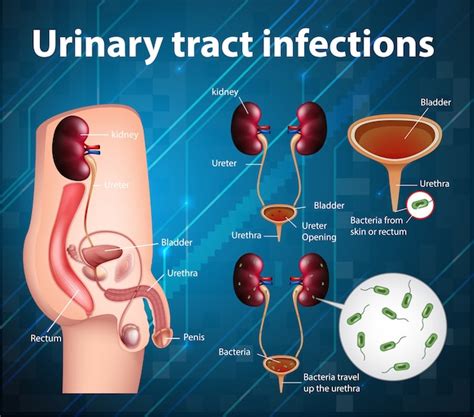 Premium Vector | Informative illustration of urinary tract infections