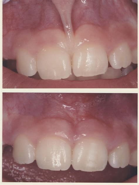 Labial Frenectomy Before And After