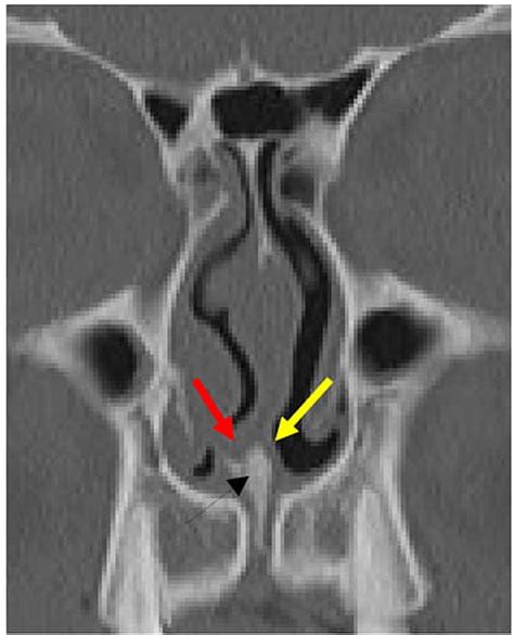 Coronal CT image shows a submucosal cleft, the difference in bottoms of... | Download Scientific ...