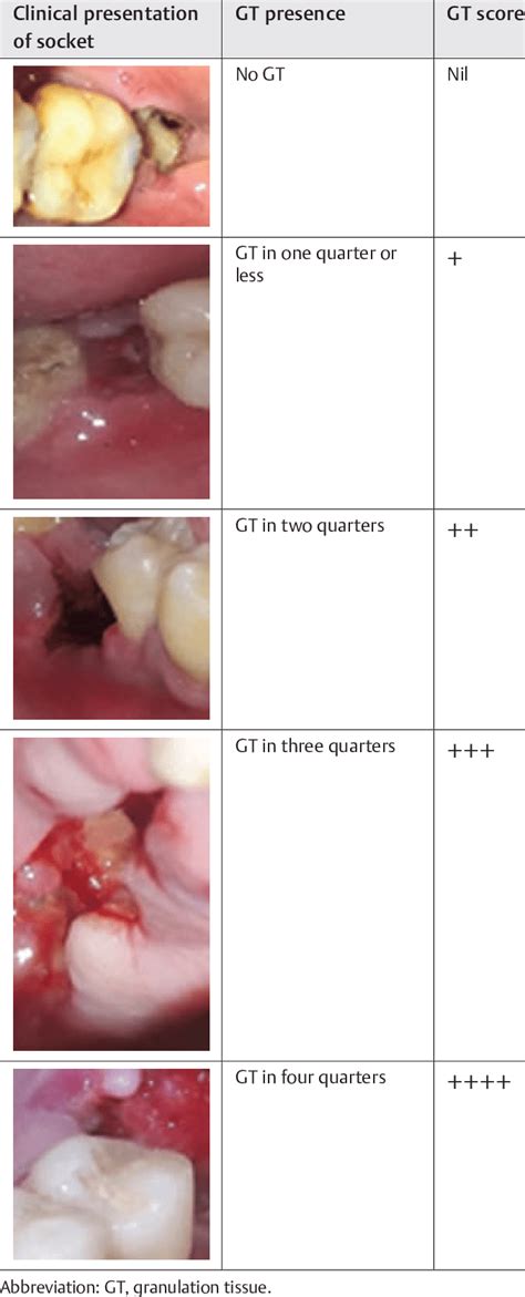 Scoring system employed for granulation tissue formation in the dry socket | Download Scientific ...