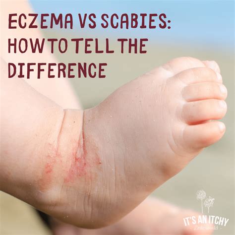 What's the Difference Between Eczema vs. Scabies? | It's an Itchy ...