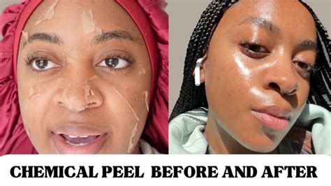 Before and After: African American Chemical Peel for Black Skin | Actualizado November 2024