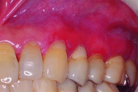 Oral Lichen Planus Gingiva