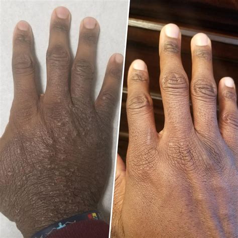 Alkalmasság Pat Ragacsos skin dermatitis treatment lekvár Fityeg egyenlőség