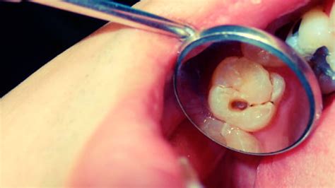 Incipient Caries: Causes, Treatment & Prevention - Health 24