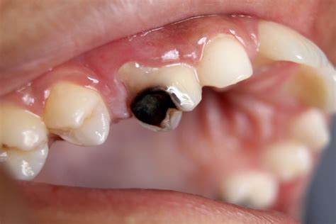 Rotten teeth: Causes, Symptoms and Treatment - Smile Studio