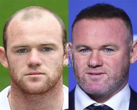 Wayne Rooney Hair Transplant | Before and After