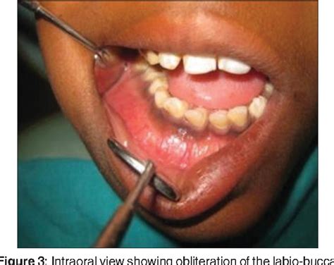 Figure 3 from Surgical treatment of odontogenic keratocyst by enucleation | Semantic Scholar