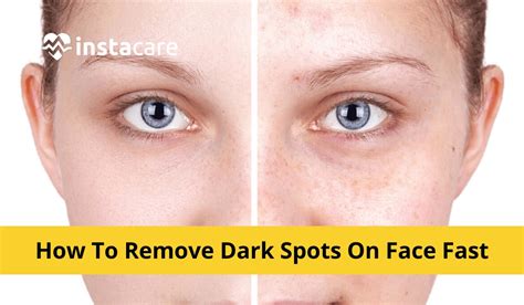 How to Remove Dark Spots on Face Fast? 7 Natural Remedies