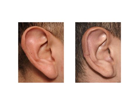 Plastic Surgery Case Study - Macrotia Reduction for Vertically Long Ears - Explore Plastic Surgery