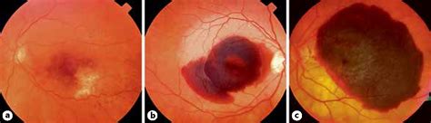 Figure 1 from Subretinal hemorrhage. | Semantic Scholar