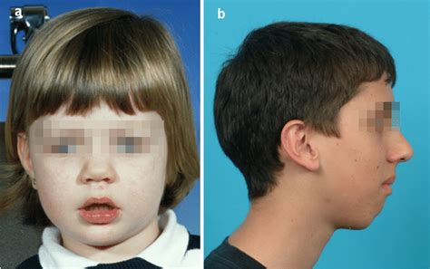 a) Patient with "adenoid facies" (open lip posture, mouth breathing ...