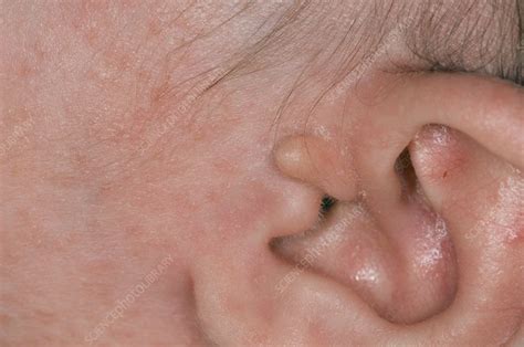 Accessory auricle ear deformity - Stock Image - C008/5639 - Science Photo Library