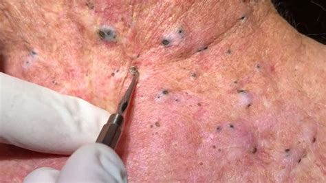 Removal Blackheads from neck Blackhead on neck - YouTube