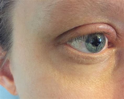Swollen Eyelid Due to Allergy | Allergies—such as to pollen,… | Flickr